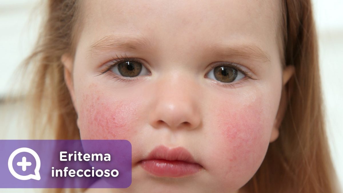 Eritema infeccioso, quinta enfermedad, parvovirus, megaloeritema, mejillas abofeteadas. pediatría, niños, mediquo.