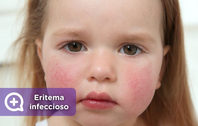 Eritema infeccioso, quinta enfermedad, parvovirus, megaloeritema, mejillas abofeteadas. pediatría, niños, mediquo.