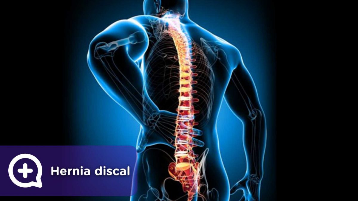 hernia discal. Mediquo. Tu amigo médico. Chat médico. Columna vertebral.