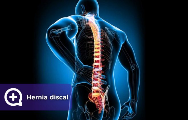 hernia discal. Mediquo. Tu amigo médico. Chat médico. Columna vertebral.