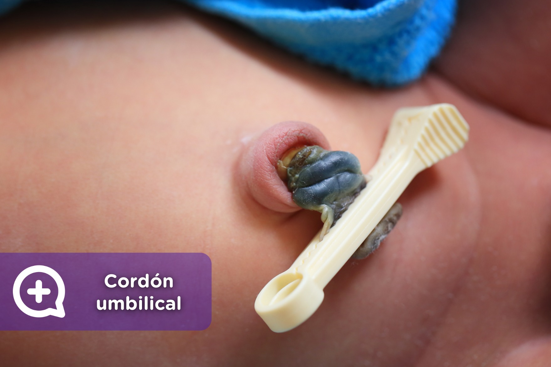 Cuidados Del Cordon Umbilical En Los Recien Nacidos Mediquo