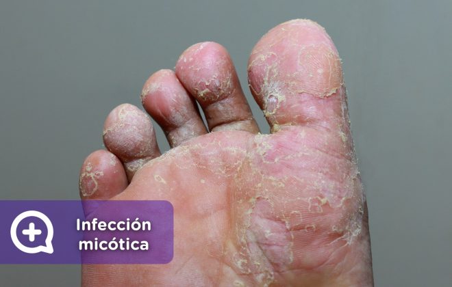 Infección micótica, micosis, pie de atleta, tiña, hongo. Mediquo. Tu amigo médico. Chat. Salud. Pies.