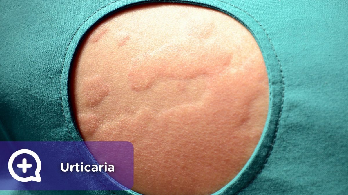 Urticaria. Picor, Piel, Dermatología. Mediquo, Tu amigo médico. Chat, App