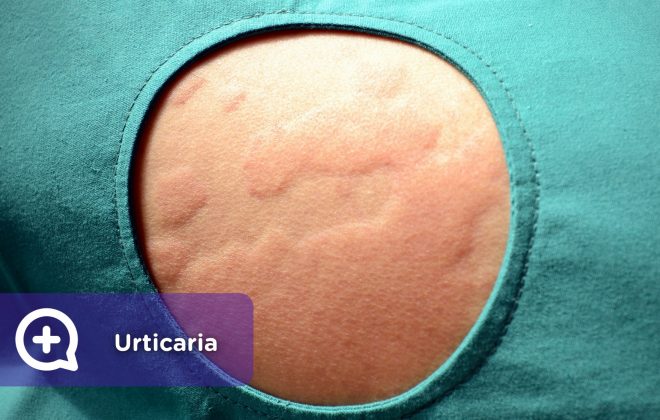 Urticaria. Picor, Piel, Dermatología. Mediquo, Tu amigo médico. Chat, App