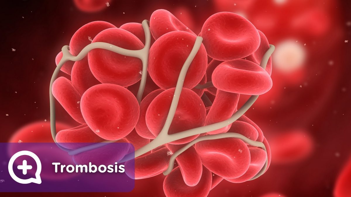 qué es la trombosis, síntomas, tipos y tratamientos. mediquo. Salud.
