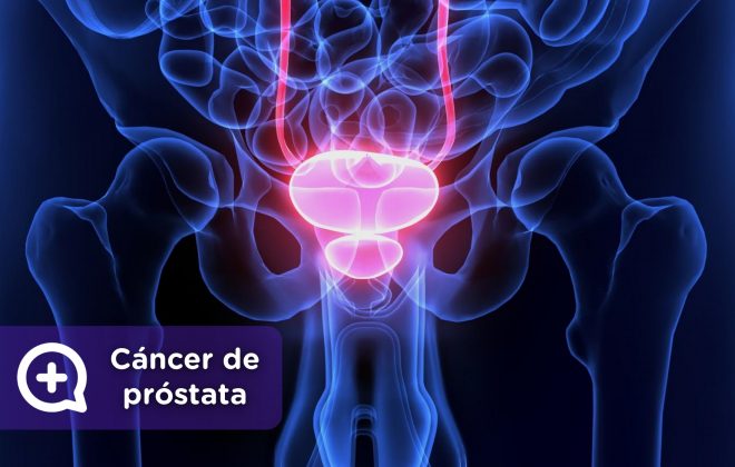 cuáles son los síntomas del cáncer de próstata. información, tratamiento, diagnóstico. Salud. Mediquo.