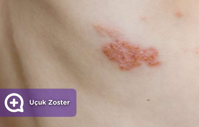 Herpes zoster virüsü, suçiçeği, enfeksiyon. MediQuo