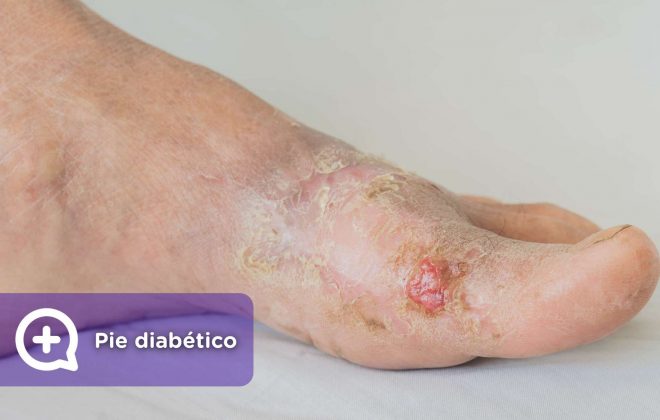 pie diabético, diabetes, podologo, úlcera, tratamiento, medicación, insulina. mediquo, telemedicina,, salud.pie diabético, diabetes, podologo, úlcera, tratamiento, medicación, insulina. mediquo, telemedicina,, salud.pie diabético, diabetes, podologo, úlcera, tratamiento, medicación, insulina. mediquo, telemedicina,, salud.pie diabético, diabetes, podologo, úlcera, tratamiento, medicación, insulina. mediquo, telemedicina,, salud.pie diabético, diabetes, podologo, úlcera, tratamiento, medicación, insulina. mediquo, telemedicina,, salud.pie diabético, diabetes, podologo, úlcera, tratamiento, medicación, insulina. mediquo, telemedicina,, salud.pie diabético, diabetes, podologo, úlcera, tratamiento, medicación, insulina. mediquo, telemedicina,, salud.pie diabético, diabetes, podologo, úlcera, tratamiento, medicación, insulina. mediquo, telemedicina,, salud.pie diabético, diabetes, podologo, úlcera, tratamiento, medicación, insulina. mediquo, telemedicina,, salud.pie diabético, diabetes, podologo, úlcera, tratamiento, medicación, insulina. mediquo, telemedicina,, salud.pie diabético, diabetes, podologo, úlcera, tratamiento, medicación, insulina. mediquo, telemedicina,, salud.