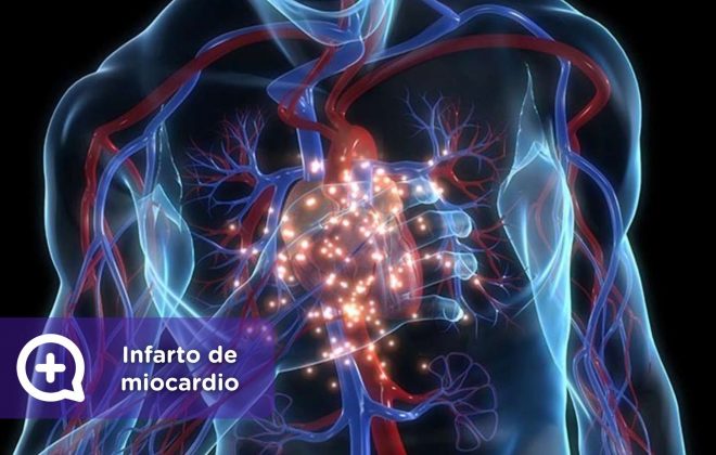 infarto de miocardio, salud, mediquo, angina de pecho, corazón, telemedicina, app, chat medico.