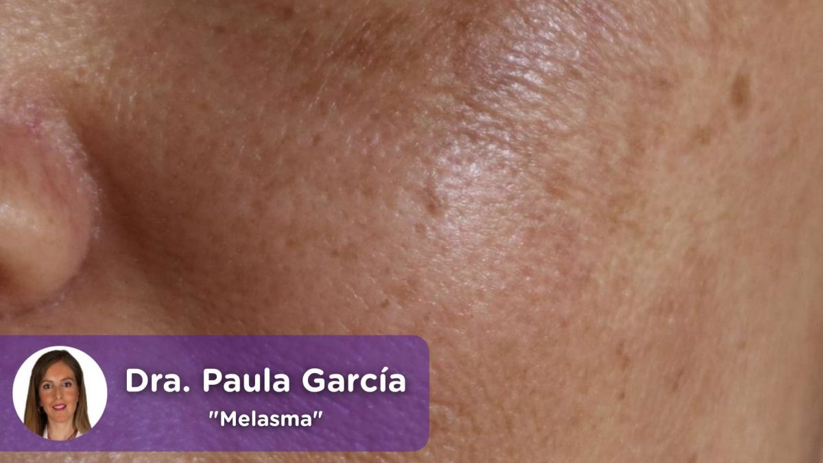 Melasma, mancha solar, piel, pigmentación, mujer, protección solar, exposición solar, rayos, cáncer de piel, mediQuo, Paula García Amorós