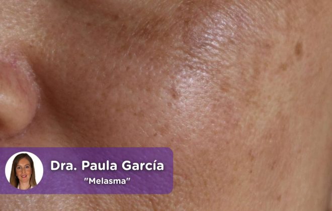 Melasma, mancha solar, piel, pigmentación, mujer, protección solar, exposición solar, rayos, cáncer de piel, mediQuo, Paula García Amorós