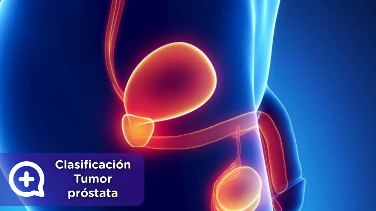 Tumor próstata, salud masculina, hombres, cáncer, testículos, urología, aparato reproductor másculino. Mediquo, consulta online.