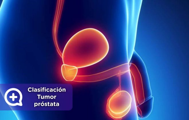 Tumor próstata, salud masculina, hombres, cáncer, testículos, urología, aparato reproductor másculino. Mediquo, consulta online.