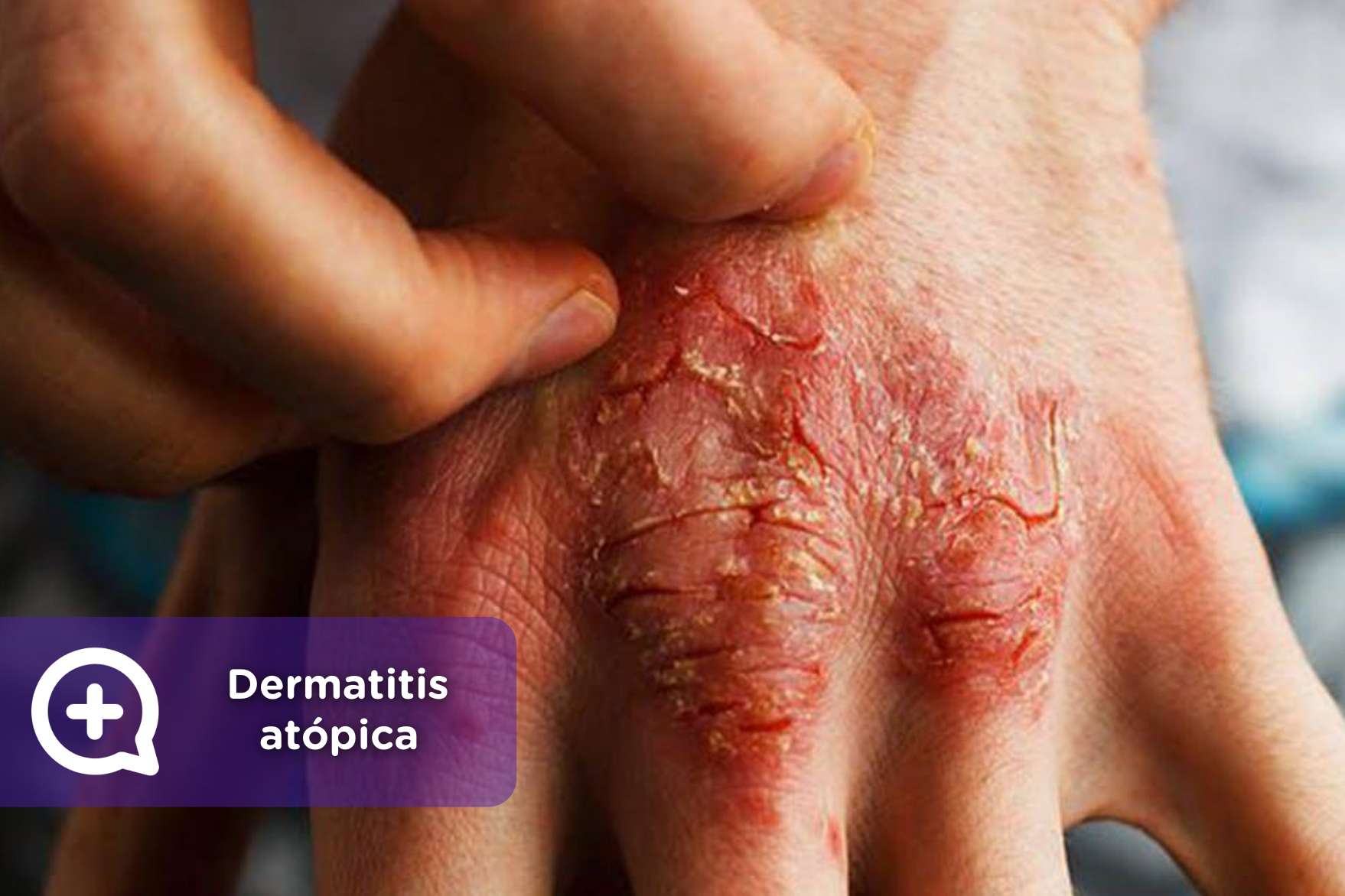 10 recomendaciones para evitar brotes de dermatitis atópica - mediQuo