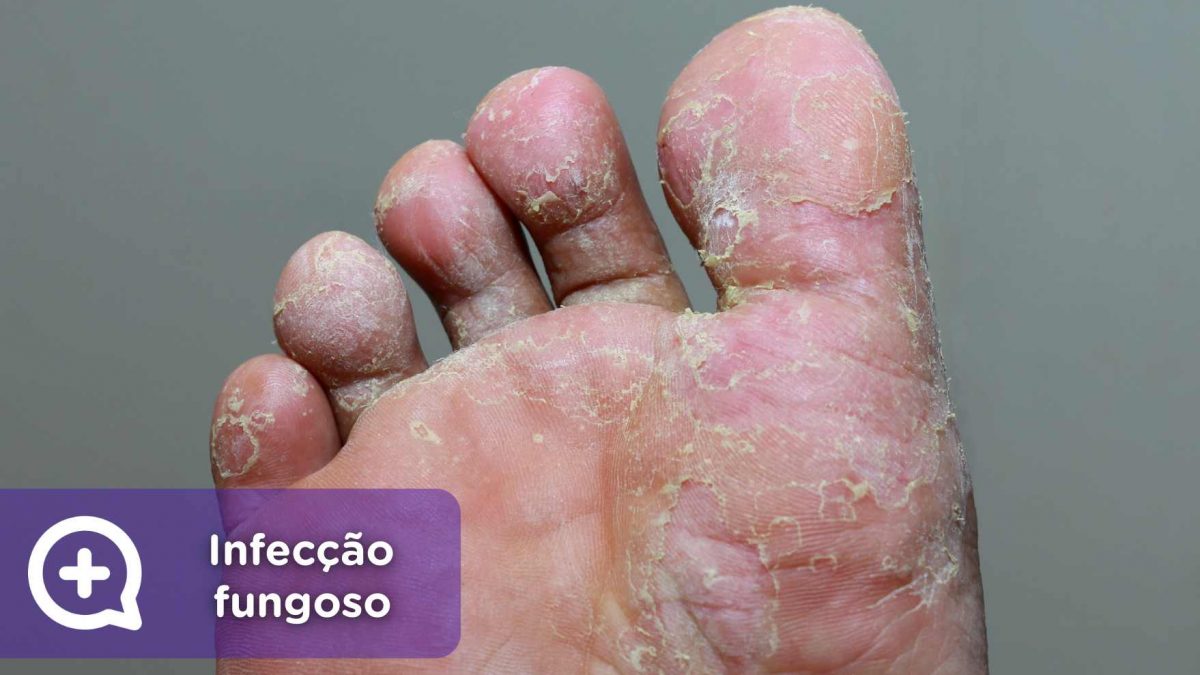 mediquo Infecção, Infecção fungoso, micose, pele, saúde