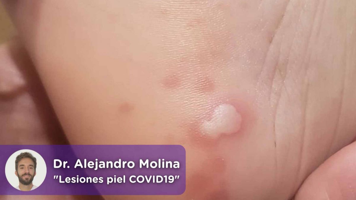lesiones piel covid19, erupciones, dermatología, dermatólogo, mediQuo, Chat médico, Alejandro Molina, Salud