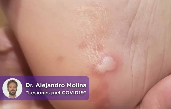 lesiones piel covid19, erupciones, dermatología, dermatólogo, mediQuo, Chat médico, Alejandro Molina, Salud