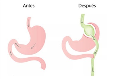 Bypass gástrico, cirugía bariátrica, obesidad, cirujano, mediquo, salud