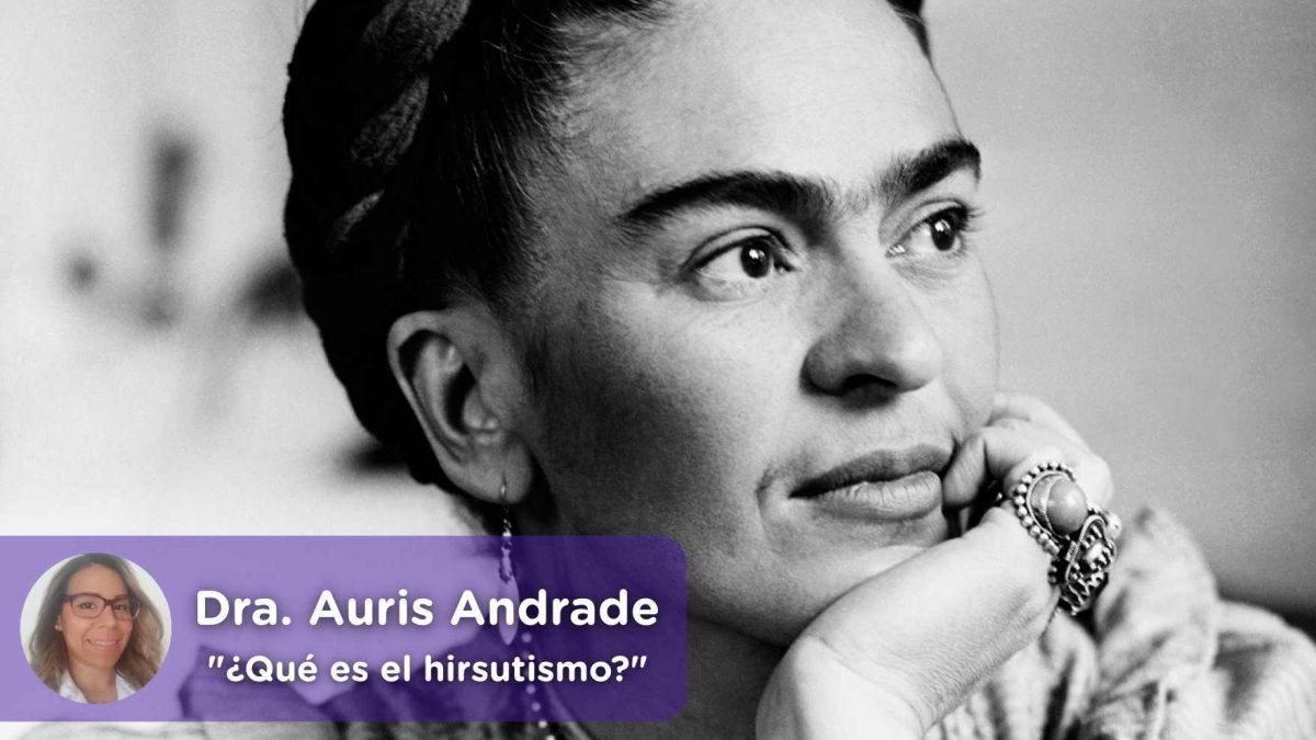 Hirsutismo, andrógenos, hormonas, vello, pelos, sop, frida khalo, mediquo, salud, mujer, ginecología