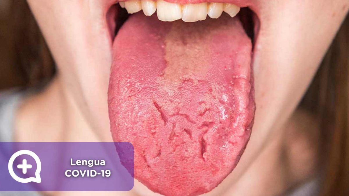 Lengua covid-19, covid, coronavirus, síntomas, sars-cov-2, mediQuo, consulta