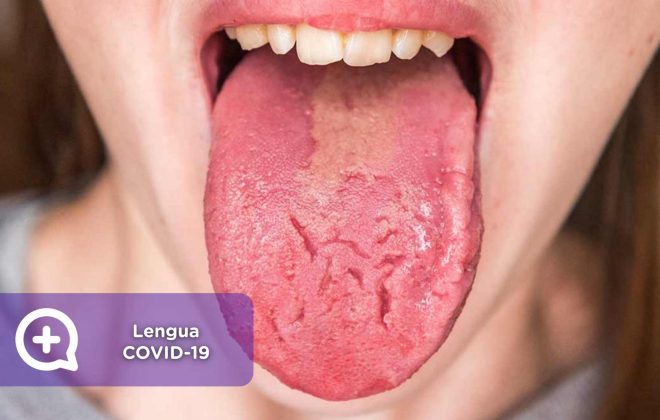 Lengua covid-19, covid, coronavirus, síntomas, sars-cov-2, mediQuo, consulta