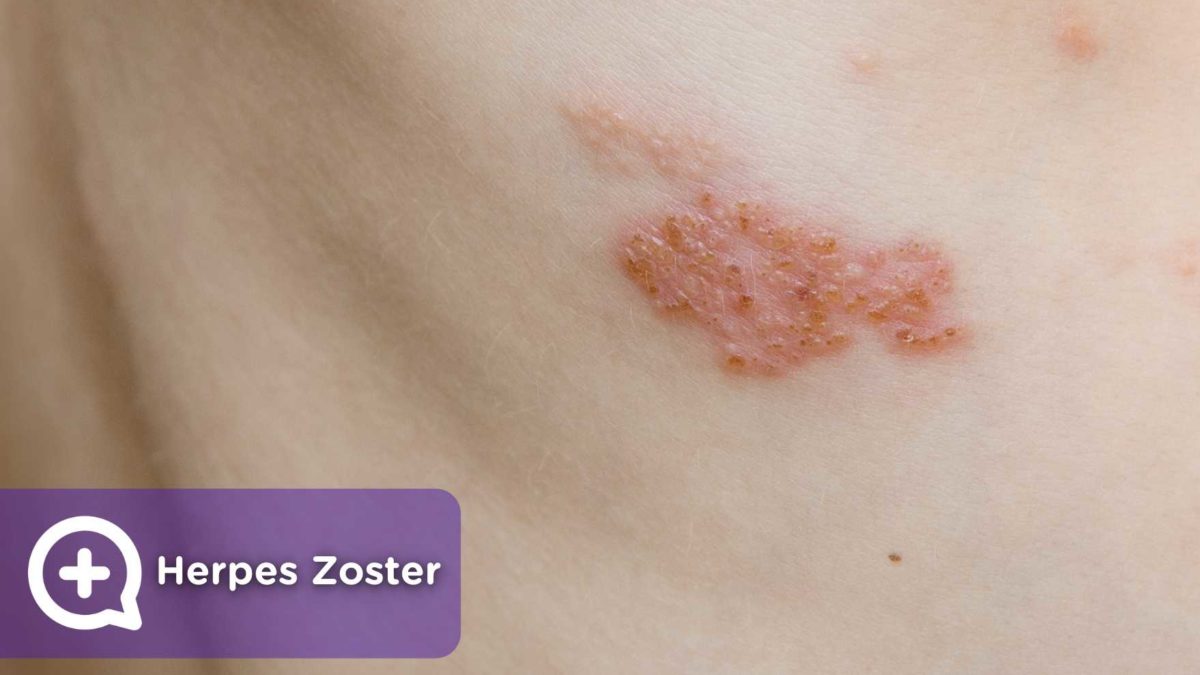 Herpes-Zoster-Virus mediQuo