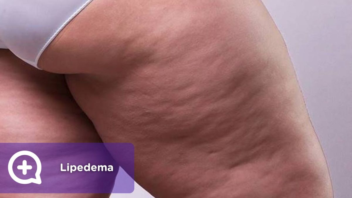 Lipedema. Artículo Blog. MediQuo. Enfermedad crónica tejido graso.