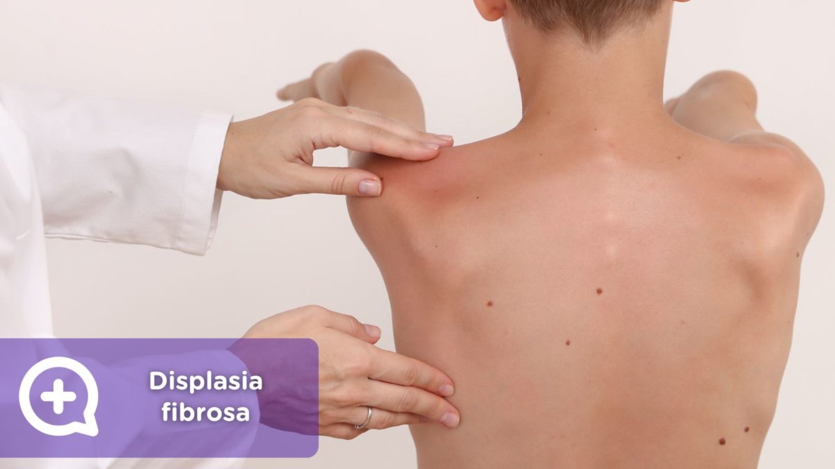 Displasia fibrosa. Tejido óseo. Mediquo. Salud.