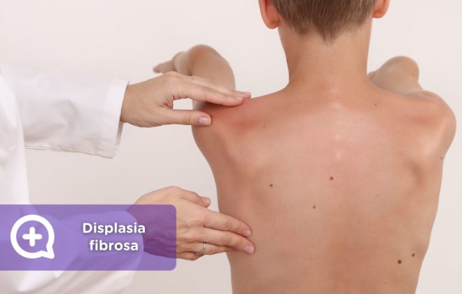 Displasia fibrosa. Tejido óseo. Mediquo. Salud.