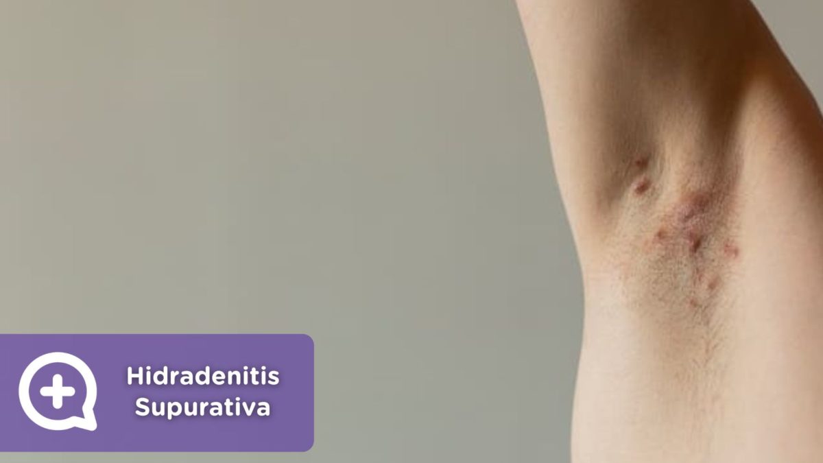 Hidradenitis Supurativa Blog. Enfermedad. Piel. Dermatología. Salud. MediQuo.