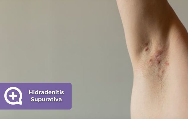 Hidradenitis Supurativa Blog. Enfermedad. Piel. Dermatología. Salud. MediQuo.