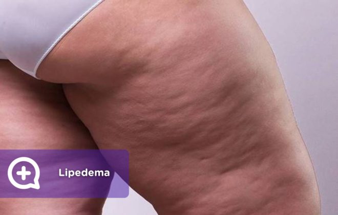 Lipedema. Mediquo.