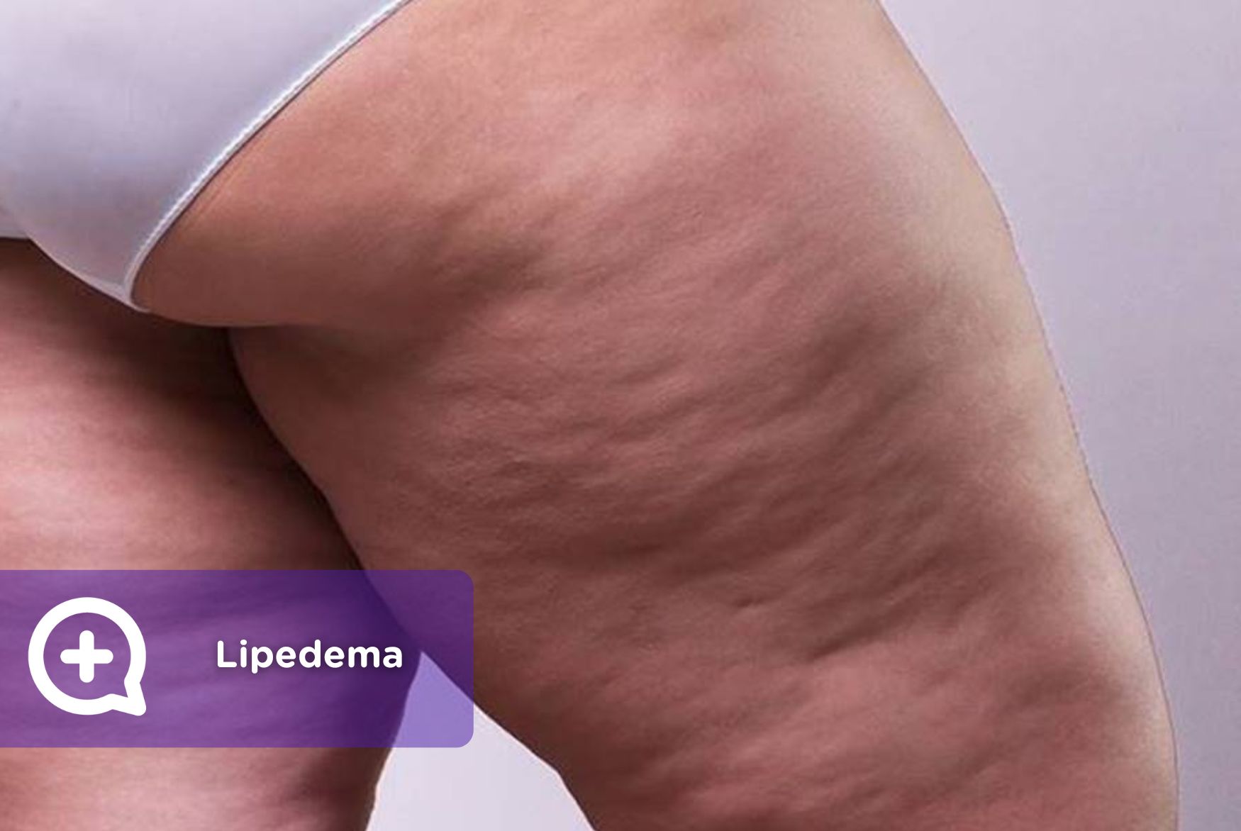 Lipedema: a doença progressiva do tecido adiposo que você deve