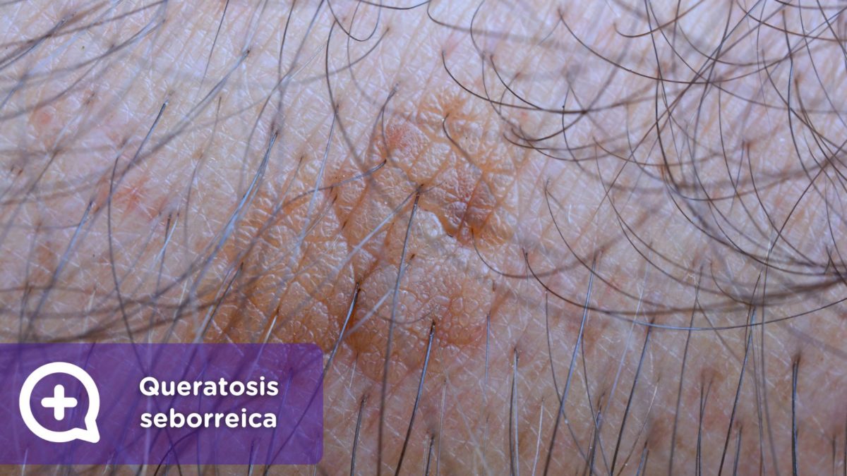 Queratosis seborreica. Dermatología. Piel. MediQuo.