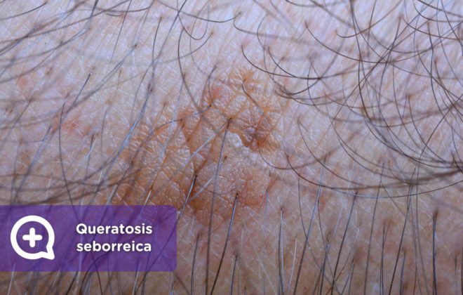 Queratosis seborreica. Dermatología. Piel. MediQuo.