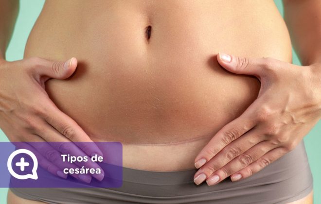 Tipos de cesária. Incisão. Aniversário. Gravidez. Ginecologia. MediQuo.