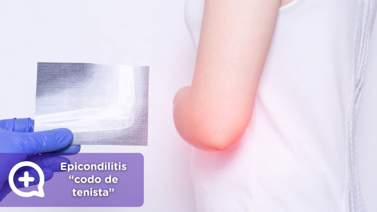 La epicondilitis es una afección que afecta el tendón que se conecta al epicóndilo lateral del hueso del brazo