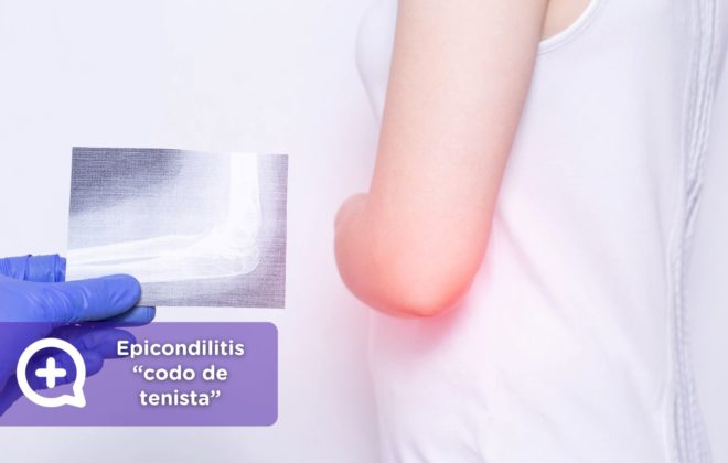 La epicondilitis es una afección que afecta el tendón que se conecta al epicóndilo lateral del hueso del brazo