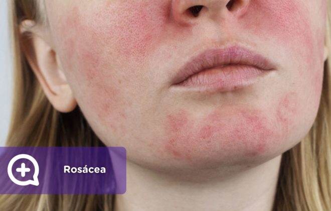 Rosácea. Enfermedad crónica de la piel. MediQuo. Dermatología.