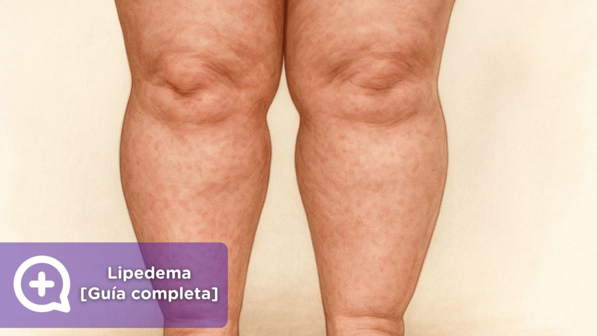 Lipedema qué es, síntomas, diagnóstico y tratamiento en España [Guía Completa 2025]