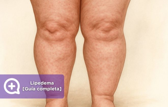 Lipedema qué es, síntomas, diagnóstico y tratamiento en España [Guía Completa 2025]